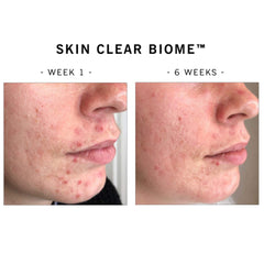 ANP 4合1排毒抗醣益生菌療程 (專利配方) Skin Clear Biome™