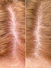 Alpha-H 去角質強健頭皮護理