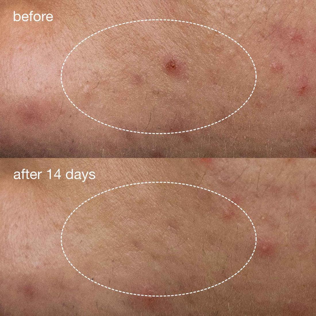 [香港行貨] dermalogica 深層淨痘精華液體貼 deep breakout liquid patch