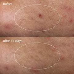 [香港行貨] dermalogica 深層淨痘精華液體貼 deep breakout liquid patch